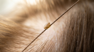 Photorealistic macro close-up of a single oval lice nit cemented near the scalp on a strand of medium-brown human hair, soft natural daylight, editorial parenting photography style.