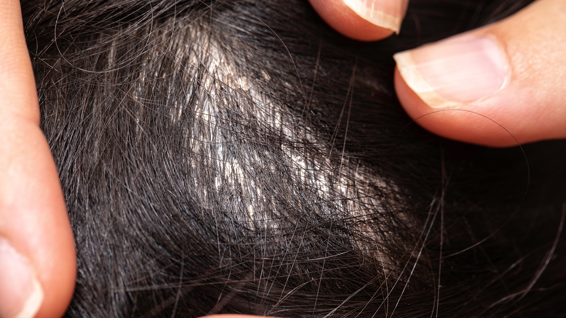 An Omaha mother parts and separates her daughter's hair under good light to check the scalp for head lice and nits after finding a single louse.
